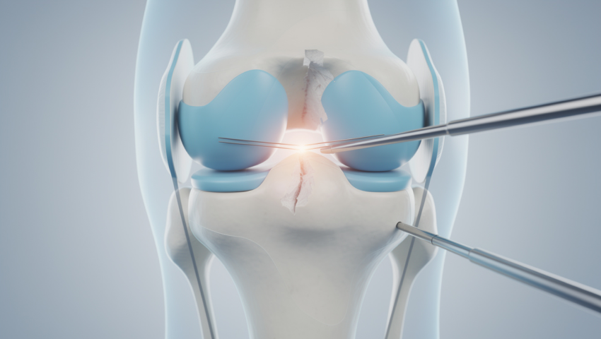 Arthroscopic Meniscal Repair