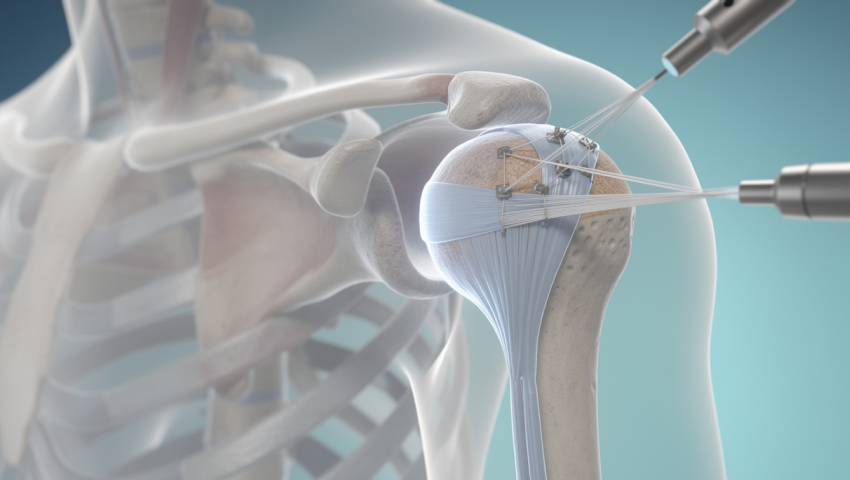 Arthroscopic Rotator Cuff Repair