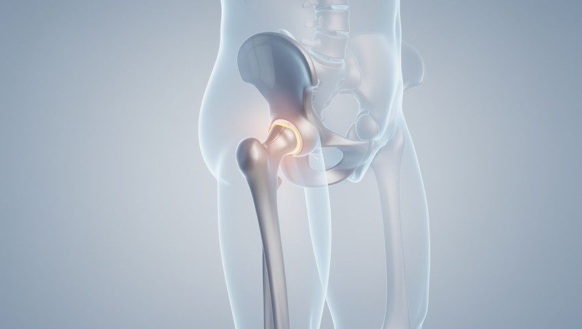 Total Hip Replacement