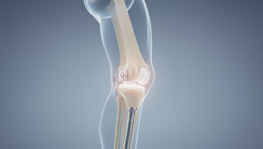 Total Knee Replacement